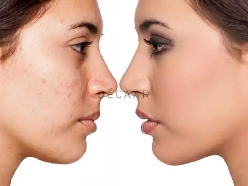 da sần sùi mụn ẩn